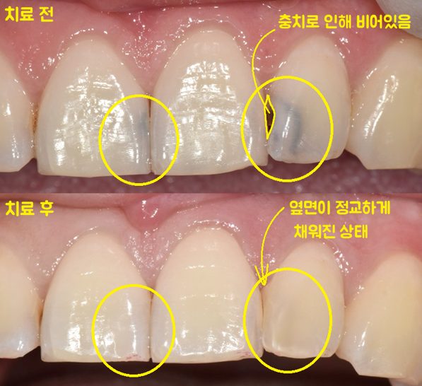 레진 충전 전 비어 있던 앞니 옆면과 충전 후 채워진 옆면을 노란 동그라미로 비교한 전후 구강 사진