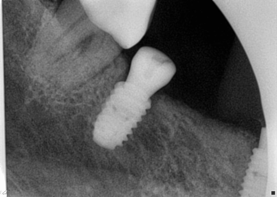 임플란트 위에 치유 지대주가 연결된 모습을 가까이 촬영한 치근단 엑스레이
