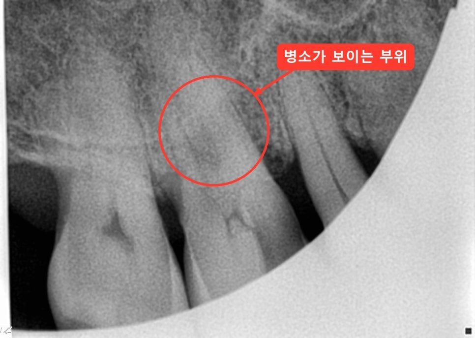 위 어금니 뿌리 끝 주변에 빨간 원으로 병소 부위를 표시한 치근단 엑스레이