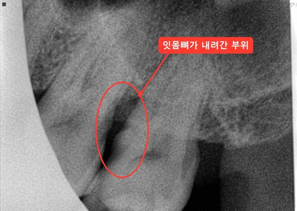 위 큰어금니 뿌리 옆을 따라 빨간 타원으로 잇몸뼈가 내려간 부위를 표시한 치근단 엑스레이
