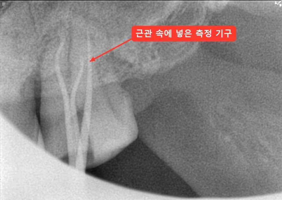 위 어금니 근관 안에 측정 기구가 들어가 있고 빨간 화살표로 기구를 가리킨 엑스레이