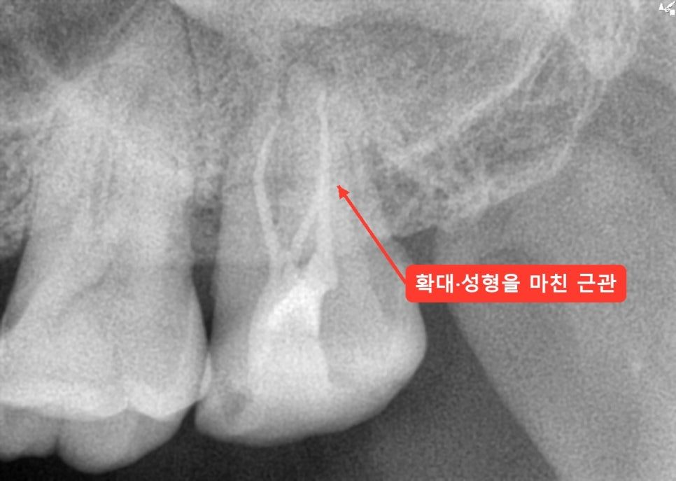 위 어금니 근관이 넓혀진 모습을 빨간 화살표로 가리킨 엑스레이