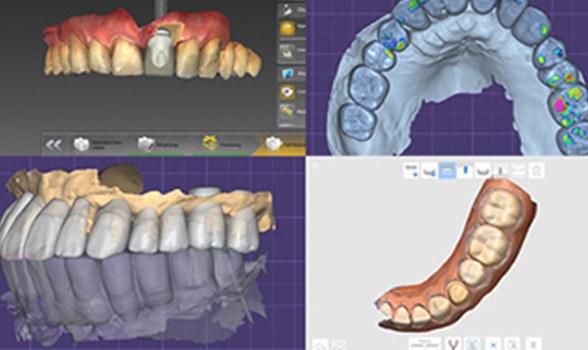 3D 임플란트 디자인 프로그램 화면